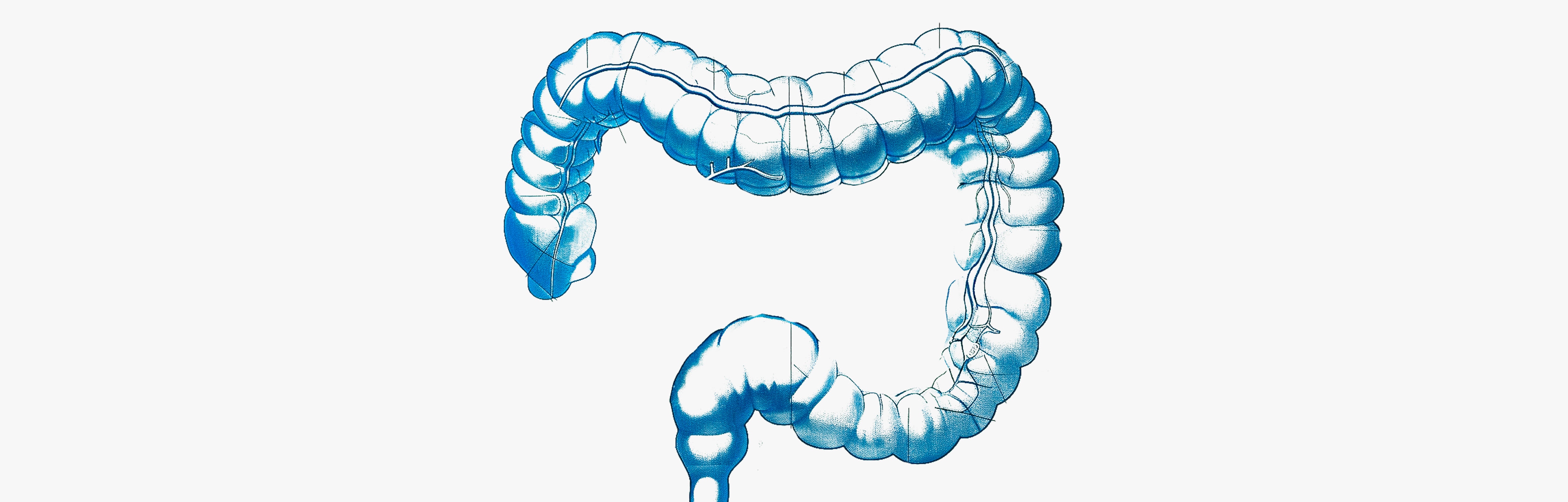 Colitis y tratamientos intestinales